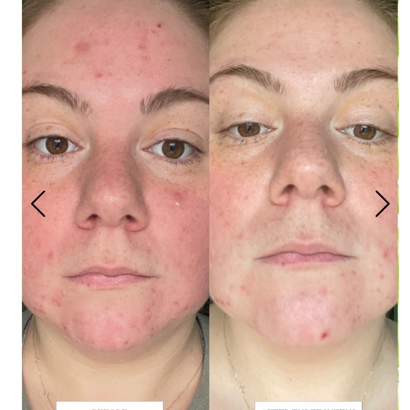 BYROE Celery AHA + LHA Resurfacing Serum 1.01 fl oz/30ml BRAND NEW/Sealed!! - Picture 4 of 12